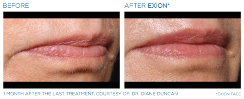 Exion face before and after