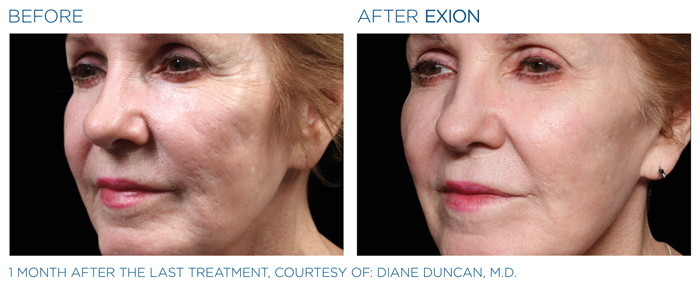 Exion RF Microneedling Before and After