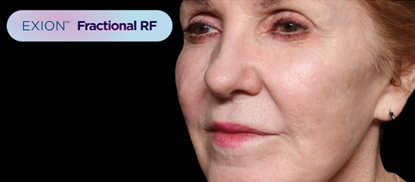 Exion Fractional RF Treatment