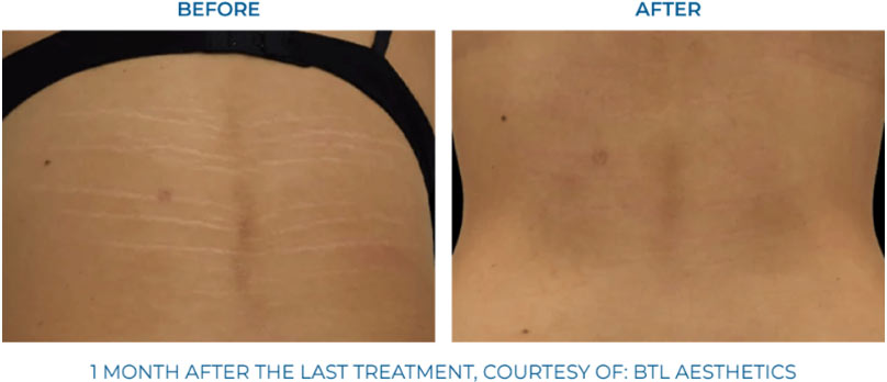 Before and after exion skin treatment for stretch marks