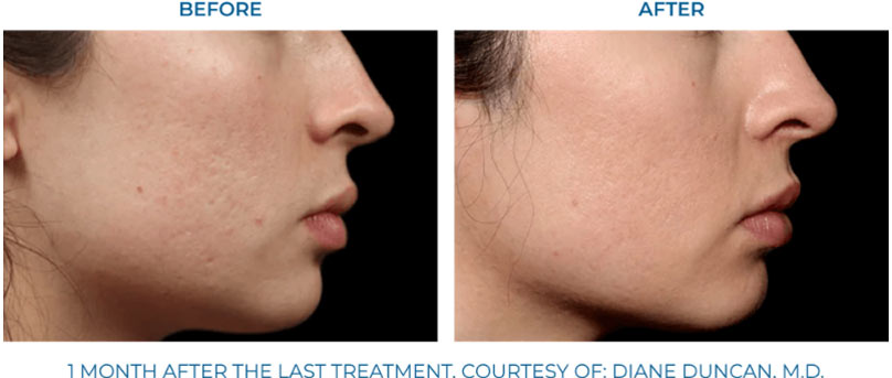 Before and after Exion skin treatment for acne scarring